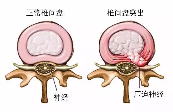 长圆针治疗腰椎间盘突出是什么原理