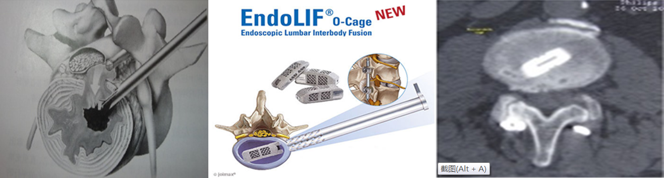 腰椎间盘突出植骨融合术你了解多少?