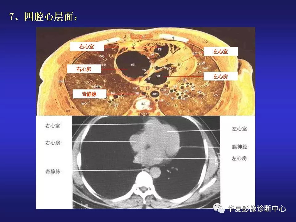 胸部ct解剖及常见病变诊断