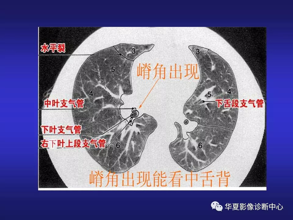 胸部ct解剖及常见病变诊断