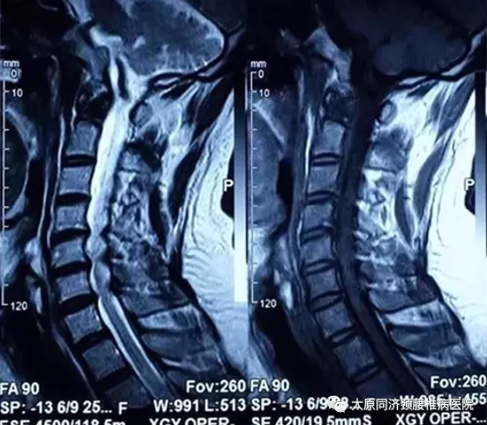 颈椎x光片提示颈椎壶顶下移,曲度较正常轻度改变.