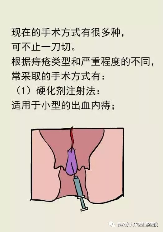 图解痔疮成因与治疗!