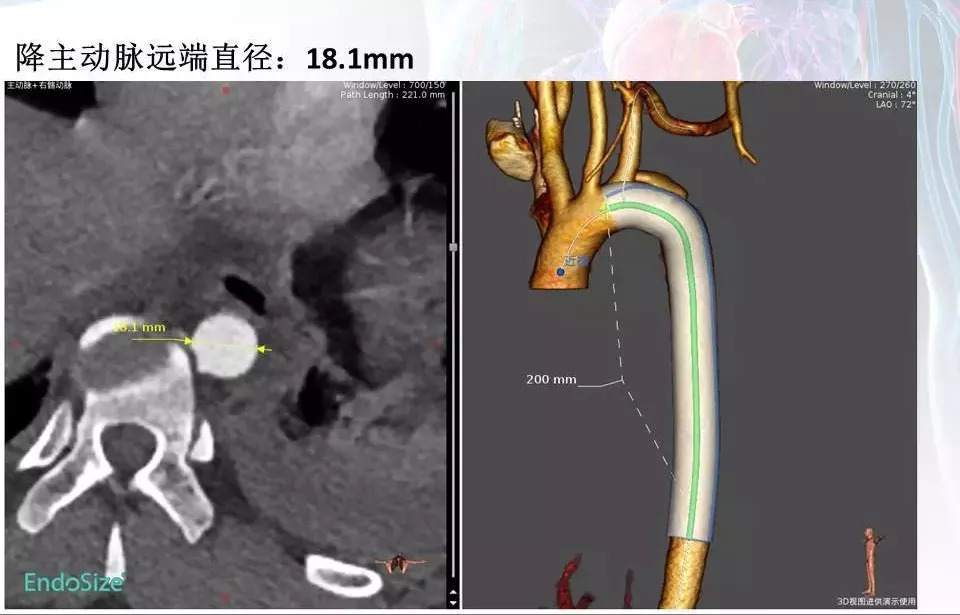 【病例分享】运用castor分支型主动脉覆膜支架系统治疗创伤性胸主动脉