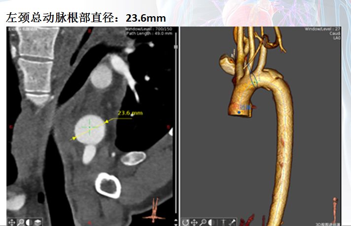 【病例分享】运用castor分支型主动脉覆膜支架系统治疗创伤性胸主动脉