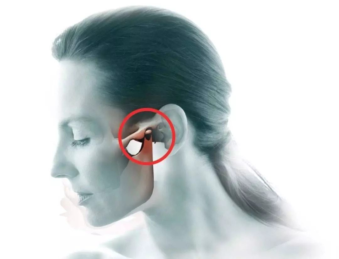 3,类风湿性关节炎:当类风湿性关节炎累及颞下颌关节时,可出现颞下颌