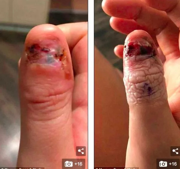 震惊!澳95后美女因为咬指甲患上癌症,被迫截肢,吓得浑身发抖!