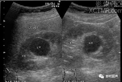 肾脏疾病—肾囊肿(renal cyst)声像图