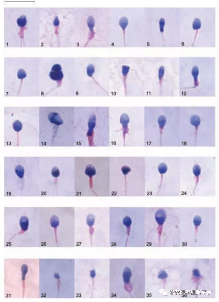 与正常形态精子区分困难.