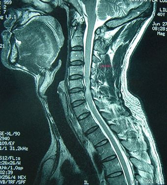 正确的检查应该是去医院查颈椎mri,核磁共振能三维重建颈椎和椎间盘