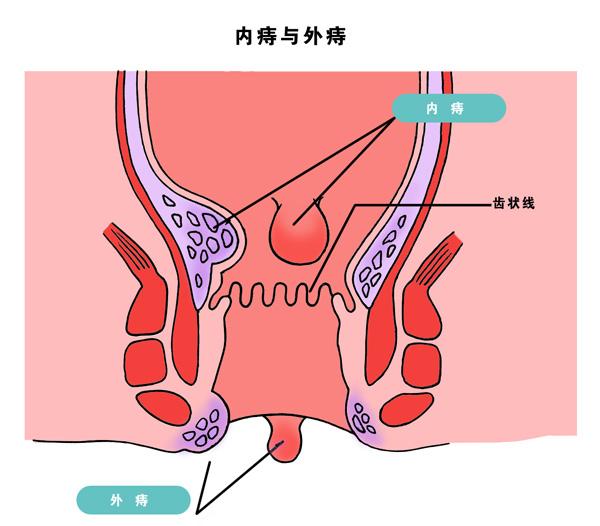 直肠癌,痔疮傻傻分不清?其实只要1招,就能轻松辨别