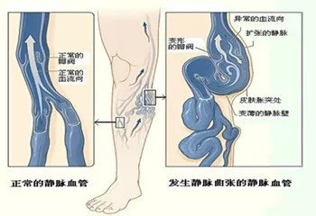 大隐静脉曲张是全身最长的皮下浅静脉,在足背内侧起自足背静脉,在下肢