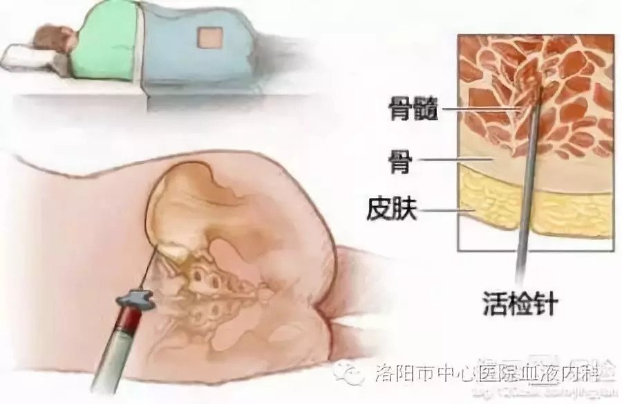 骨穿的方法其实很简单,一般是在髂骨前(或后)上嵴或胸骨部位,局部注射