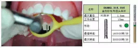 避免损伤附着龈.