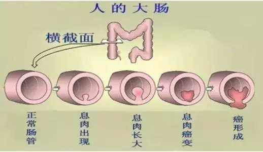 没有临床症状,40% ～50%的结直肠癌患者也是没有报警症状的