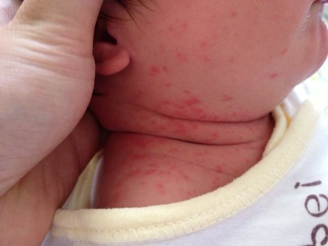 湿痒反反复复如何减轻换季宝宝皮肤过敏红痒