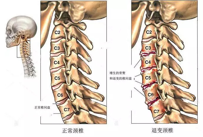 颈椎病人口_颈椎病的症状图片(2)