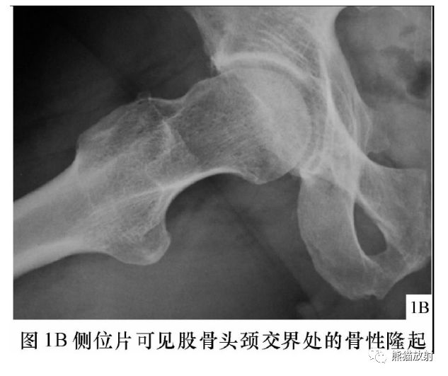 髋关节撞击综合征fai丨影像表现