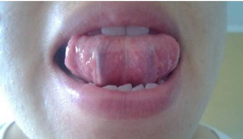 卷起你的舌头,看看舌下是不是有两条"黑线"?