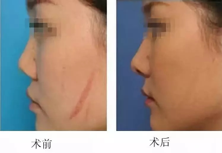 3,传统的疤痕修复手术多采用割除,磨削的方式消除疤痕,实际上皮肤很