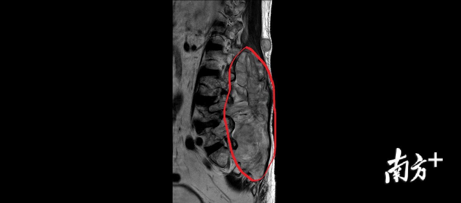 老伯腰部长"大包",医生切除它用了整整10个小时