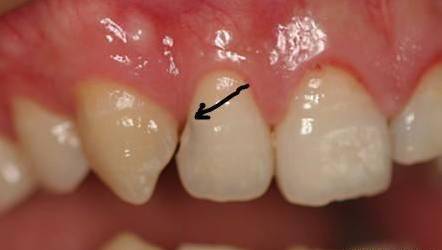 牙缝里为什么会有黑黑的东西？