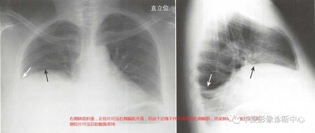局限包裹性胸腔积液怎么看X片