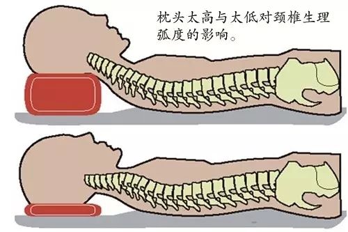 睡觉不用枕头就可治好颈椎病？千万别！