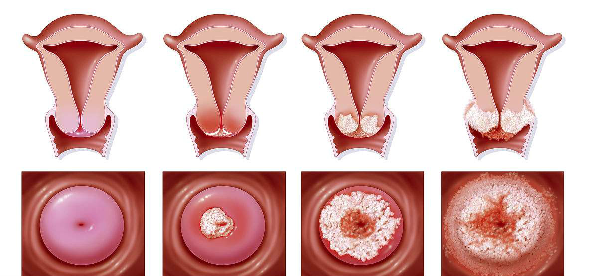 患上宫颈癌的第一步,常常是这种癌前病变,别再拒绝妇科检查了!