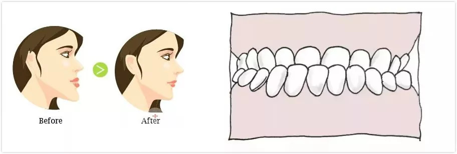 这些牙齿不齐问题12岁前必须要矫正!