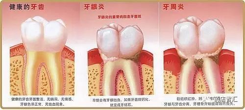 牙周炎与牙龈炎的4大区别点及联合用药方案