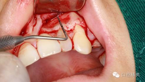 图解:左上侧切牙根尖切除术