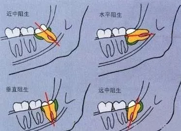 智齿生长方向示意图