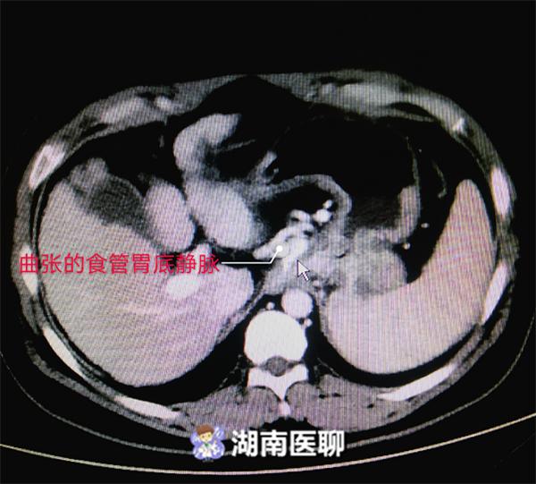 肝硬化病人口吐血_肝硬化病人图片(3)