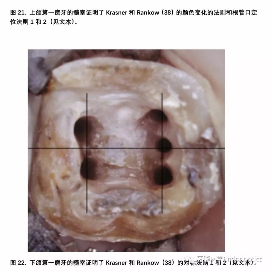 除了上颌磨牙,根管口位于与通过髓室底中心近远中方向的线垂直的线上.