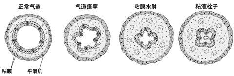 过敏性咳嗽是哮喘的一种形式病理是与哮喘一样的真的是这样吗