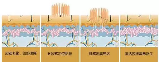 再加上肚子变大,让皮肤的弹力纤维与胶原纤维损伤或断裂,腹部皮肤变薄