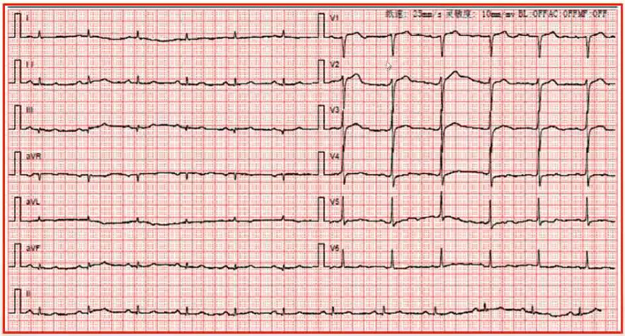 心电图:窦性心律,肢体导联低电压,v1-v6导联递增良好,v4导联t波低平