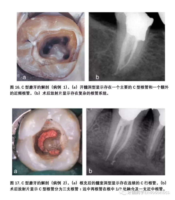 大部分 c 型根管系统在根管口处为连续的 c 型结构;但是,沿着牙齿