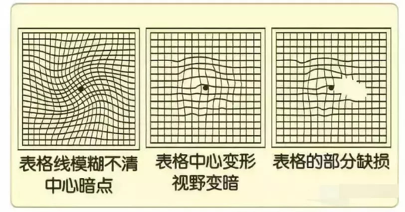 1分钟自我检测有没有得上眼病