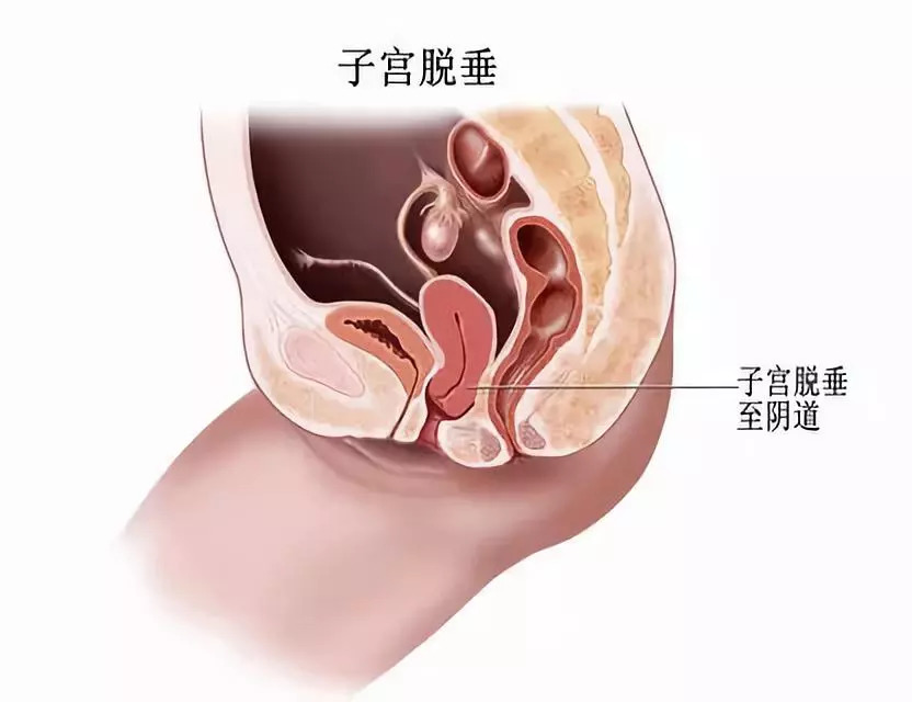 产后,把婚姻搞砸的 5 种「 盆底疾病 」