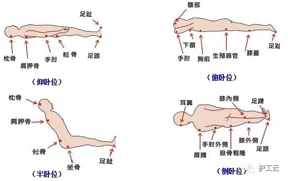 压疮易发生部位