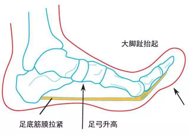 足弓训练 足趾往上翘,足底用力往下踩;每次锻炼10分钟.