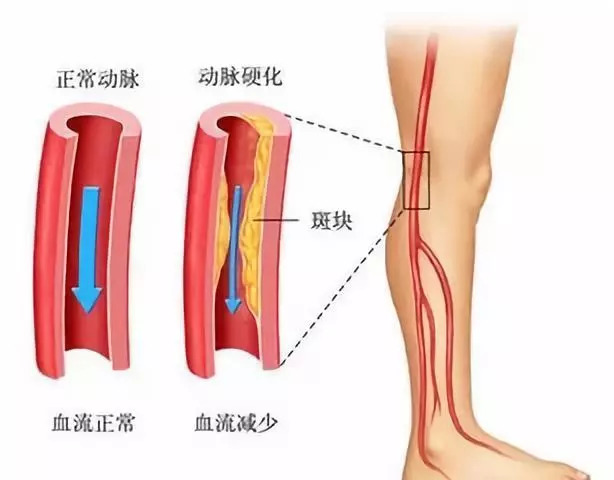 动脉堵塞严重时可能导致腿脚缺血坏死,甚至需要截肢.阅读88884400.