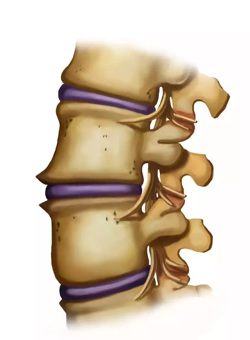 令人疼痛难忍的腰椎间盘突出究竟咋回事5位一体的保养动作快速学起来