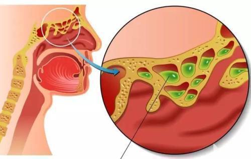 慢性咽炎不要盲目用药 找到3大根源 避免再度复发!