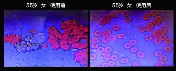 血液净化技术血液有多脏胆固醇结晶