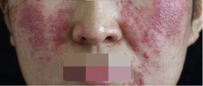 面中部红斑:玫瑰痤疮可能表现为鼻部和内侧面颊长期发红.