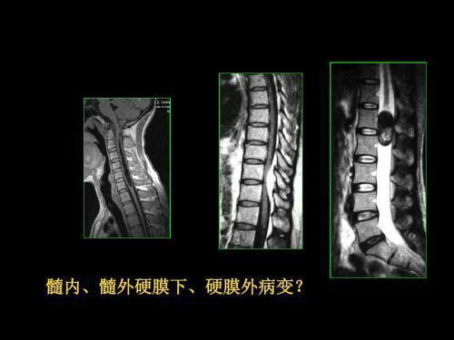 它原发或继发于椎管内 是脊髓压迫症的根源!