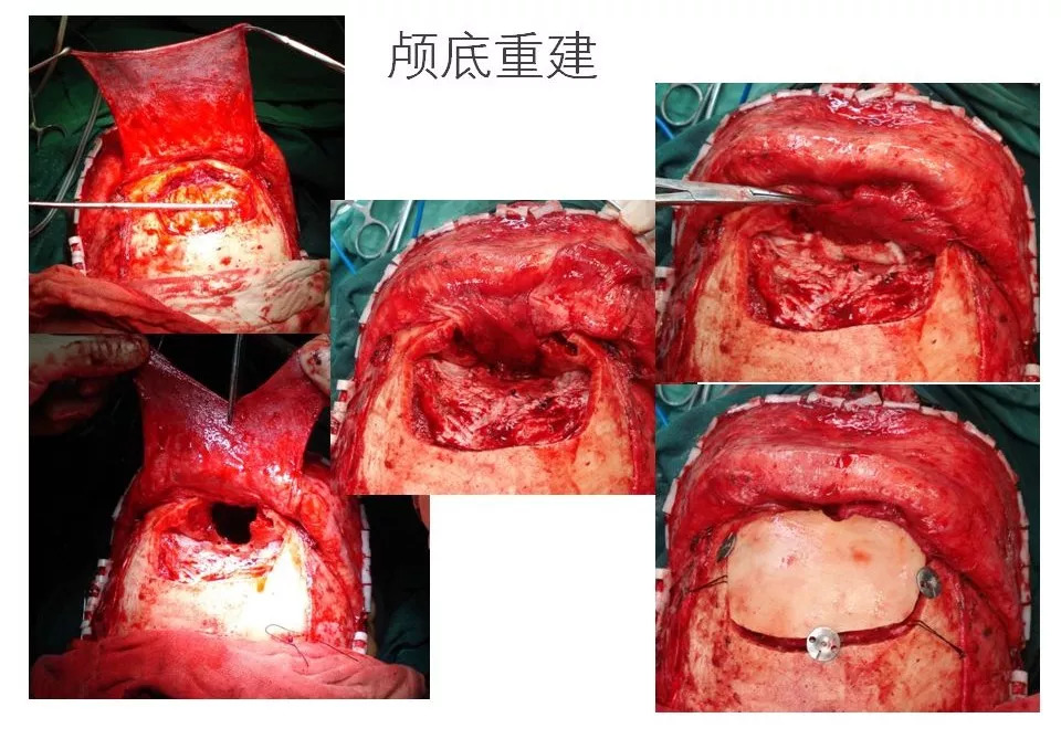 [cns2018] 医科院肿瘤医院万经海: 颅底沟通性脑膜瘤的外科治疗