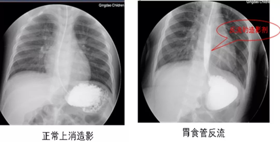青岛妇儿医院呼吸科专家提醒小儿胃食管反流性慢性咳嗽要注意